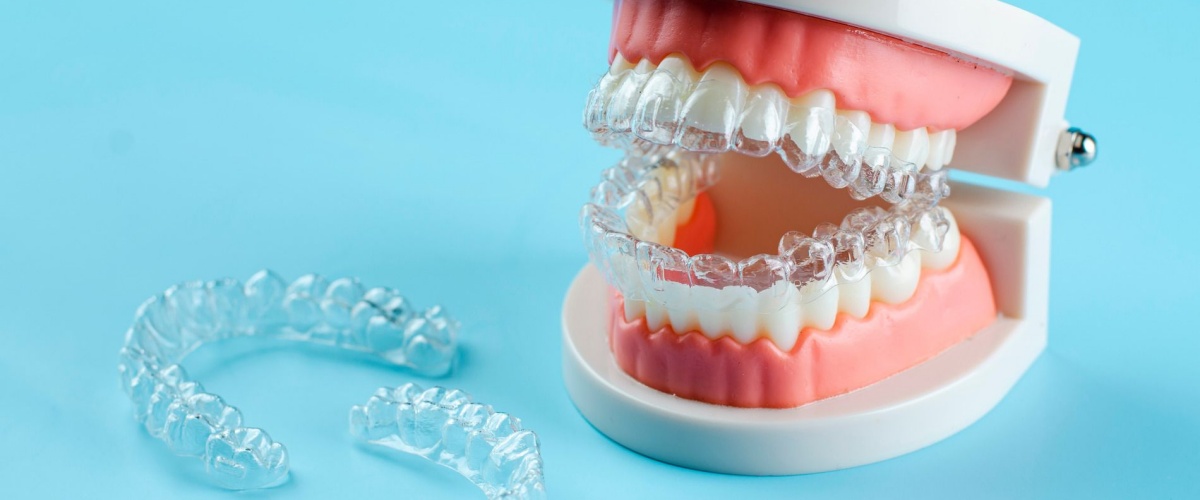 invisalign-gouttiere - Croc-Odile